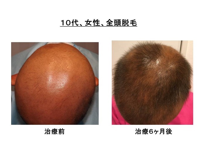 ない 効か フェ フェナジン キソ